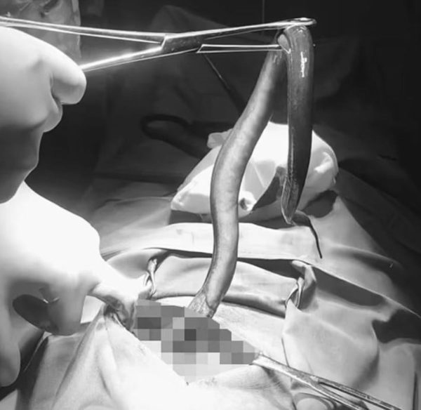 enguia-anus-homem-600x584-2